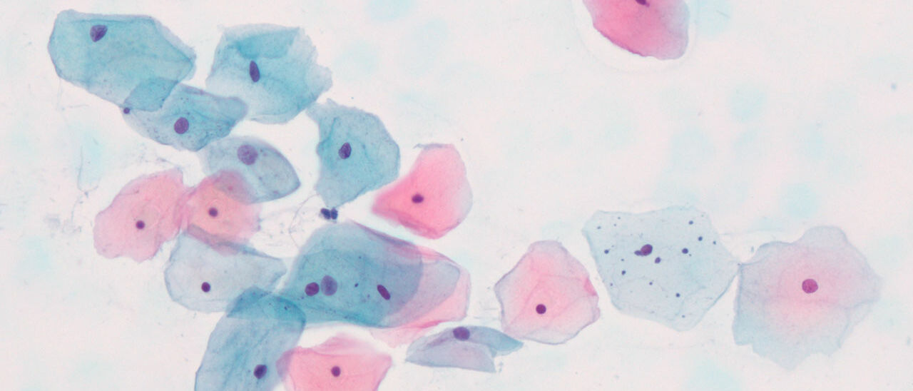 Zytologie-Probe zeigt unauffälliges Zellbild